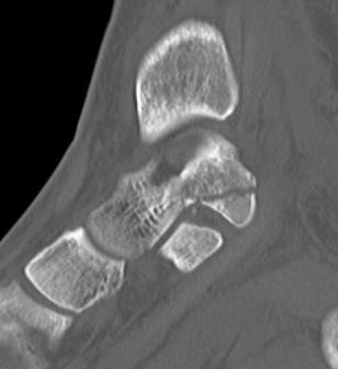 Sustenaculum Fracture CT 2